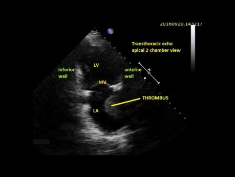 Cas intéressant à l'échocardiographie - vue apicale à 2 chambres