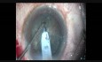 Chirurgie sans incident dans la cataracte dure utilisant le rhexis ovale