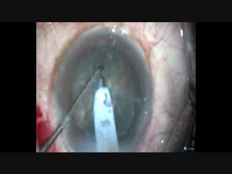 Chirurgie sans incident dans la cataracte dure utilisant le rhexis ovale