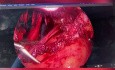 Rasage rectal et hystérectomie pour l'endométriose