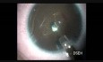 Lentille intraoculaire secondaire chez un enfant