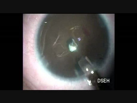 Lentille intraoculaire secondaire chez un enfant