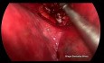 Chirurgie thoracique vidéo-assistée (CTVA) chez un patient non intubée - segmentectomie anatomique postérieure supérieure droite S2