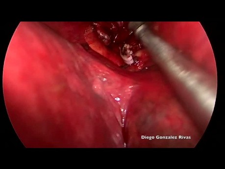 Chirurgie thoracique vidéo-assistée (CTVA) chez un patient non intubée - segmentectomie anatomique postérieure supérieure droite S2