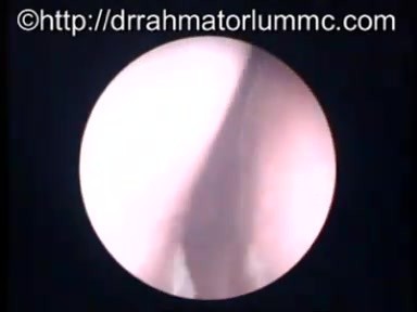 Aspect du Nasopharynx après Traitement par Radiothérapie pour Carcinome Nasopharyngé