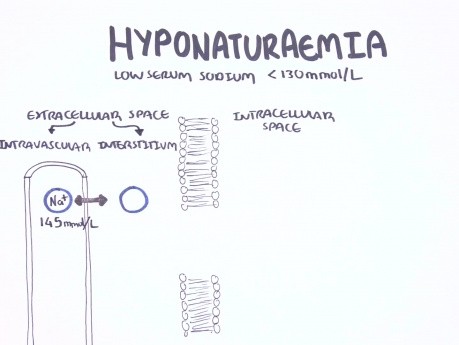 L'hyponatrémie  - la classification, les causes, la physiopathologie, le traitement