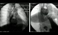 Résection sous thoracoscopie d'un grand diverticule du tiers moyen de l'œsophage adhérant à l'aorte et au hile gauche du poumon