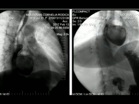 Résection sous thoracoscopie d'un grand diverticule du tiers moyen de l'œsophage adhérant à l'aorte et au hile gauche du poumon