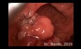 Chirurgie Trans-Anale Mini-Invasive TAMIS pour l'Adénome Villeux du Rectum
