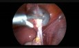 Cystadénome de l'ovaire bilatéral - ablation laparoscopique