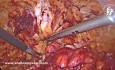 Hernie Ventrale ; Cure Endoscopique par Technique "ENDOR"