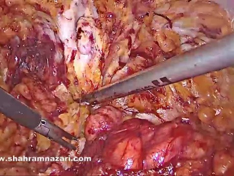 Hernie Ventrale ; Cure Endoscopique par Technique "ENDOR"