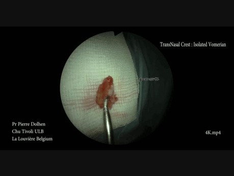 Septoplastie Endoscopique Mini-Invasive