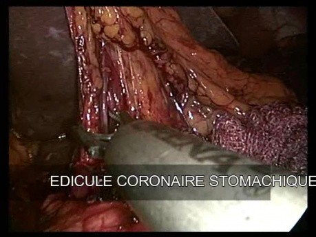 Gastrectomie Subtotale