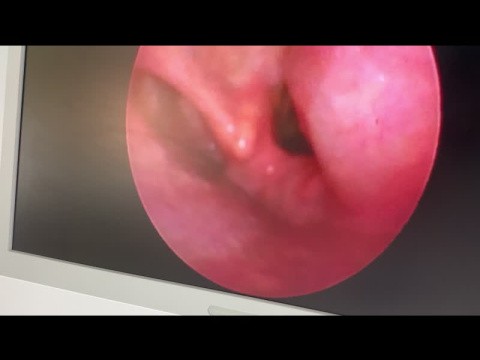 Sulco vocal