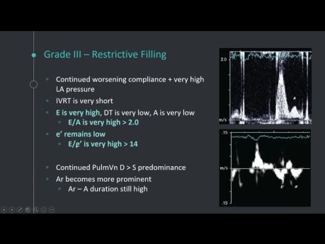 Voyage Relaxant à travers la Diastologie - Évaluation de la Fonction Diastolique en Echocardiographie