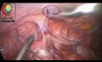 Appendicectomie Laparoscopique par Diathermie Bipolaire