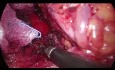 Libération laparoscopique du tronc cœliaque - syndrome du ligament arqué médian