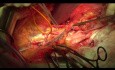 Opération cytoréductive du cancer de l'ovaire. Partie pelvienne.