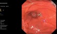 CPRE avec Gastroscope pour la Papille Intradiverticulaire