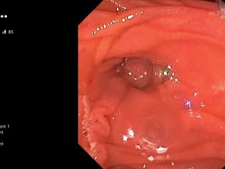 CPRE avec Gastroscope pour la Papille Intradiverticulaire