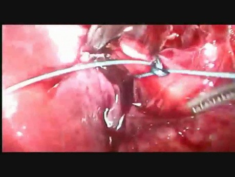 Ligature du canal cystique court