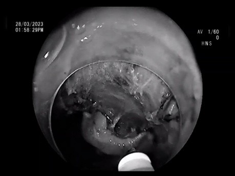 Dissection Sous-Muqueuse Endoscopique de LST-G Rectale (Tumeur d'extension latérale) (Mars 2023)