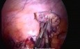 Transposition ovarienne par laparoscopie avant la radiothérapie