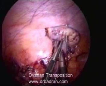 Transposition ovarienne par laparoscopie avant la radiothérapie