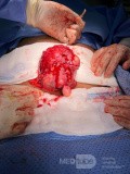 Myomectomie d'un Large Fibrome avec Préservation de l'Utérus