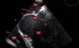 Échocardiographie transoesophagienne (ETO) - endocardite de la valve mitrale avec une petite végétation