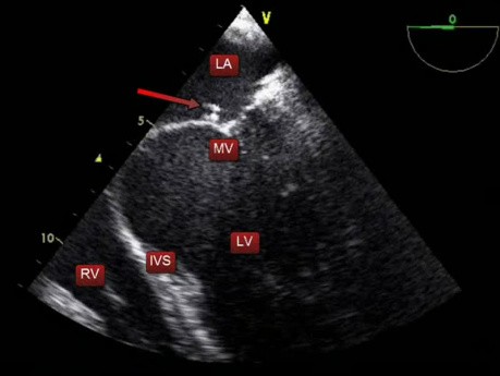 Échocardiographie transoesophagienne (ETO) - endocardite de la valve mitrale avec une petite végétation