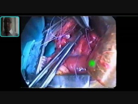 Atrésie de l'œsophage avec fistule trachéo-œsophagienne - chirurgie