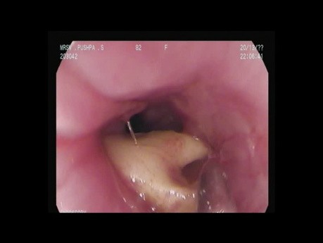 Os de mouton impacté - Oesophage supérieur - Désobstruction 