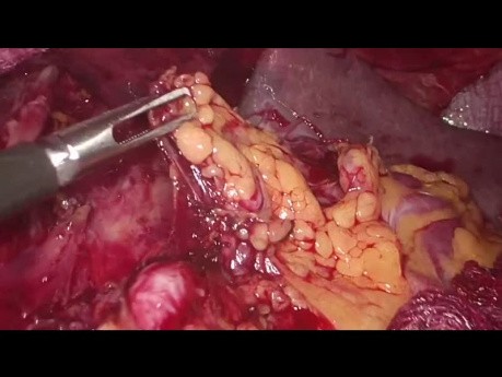 Gastrectomie laparoscopique avec curage ganglionnaire D2 - Étapes clés de la procédure chirurgicale