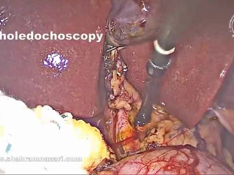Pose d'un Stent Antérograde du Cholédoque Après Exploration Laparoscopique