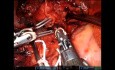 Lobectomie Bronchique Supérieure Droite Entièrement Robotisée (URATS) avec Reconstruction Vasculaire