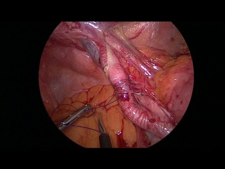 Traitement laparoscopique d'une hernie interne étranglée sous l'artère iliaque externe avec reconstruction en utilisant le péritoine pariétal