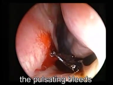 Saignement De Nez - Cautérisation Avec TCA 50%