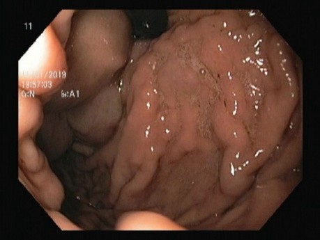L'injection de colle dans le fundus & ligature endoscopique des varices oesophagiennes