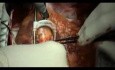 Greffe de pontage coronarien - PAC - Anesthésie péridurale