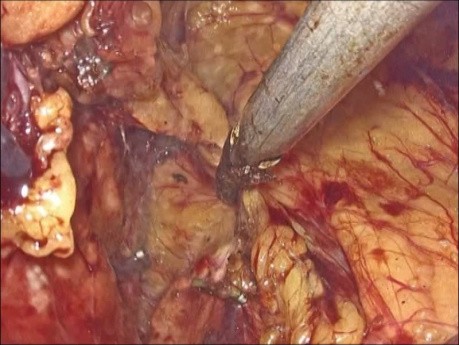 Surrénalectomie gauche par voie laparoscopique pour adénome. Approche latérale transpéritonéale