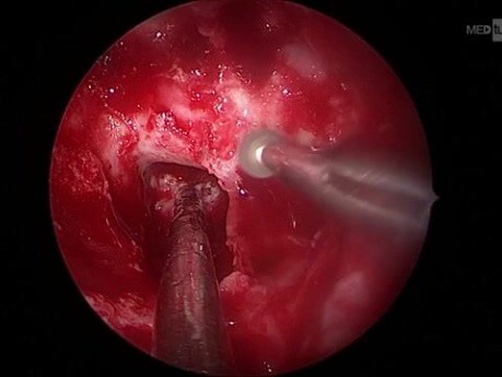 Chirurgie Transsphénoïdale Transnasale pour Résection d'Adénome Hypophysaire - Patient Acromégale