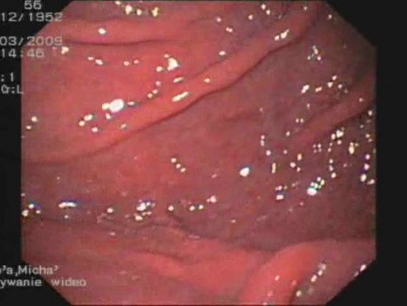 Varices œsophagiennes- grade III . La gastropathie d'hypertension portale