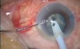 Chirurgie de la cataracte - phacoémulsification - technique stop-and-chop