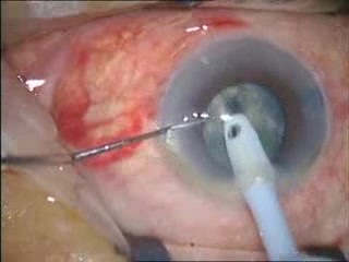 Chirurgie de la cataracte - phacoémulsification - technique stop-and-chop