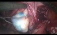 Localiser les myomes lors d'une myomectomie laparoscopique