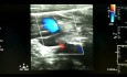 La dissection carotidienne