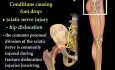 Lésion du nerf fibulaire - Pied tombant
