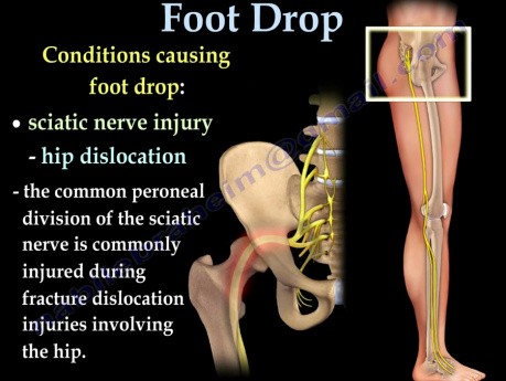 Lésion du nerf fibulaire - Pied tombant